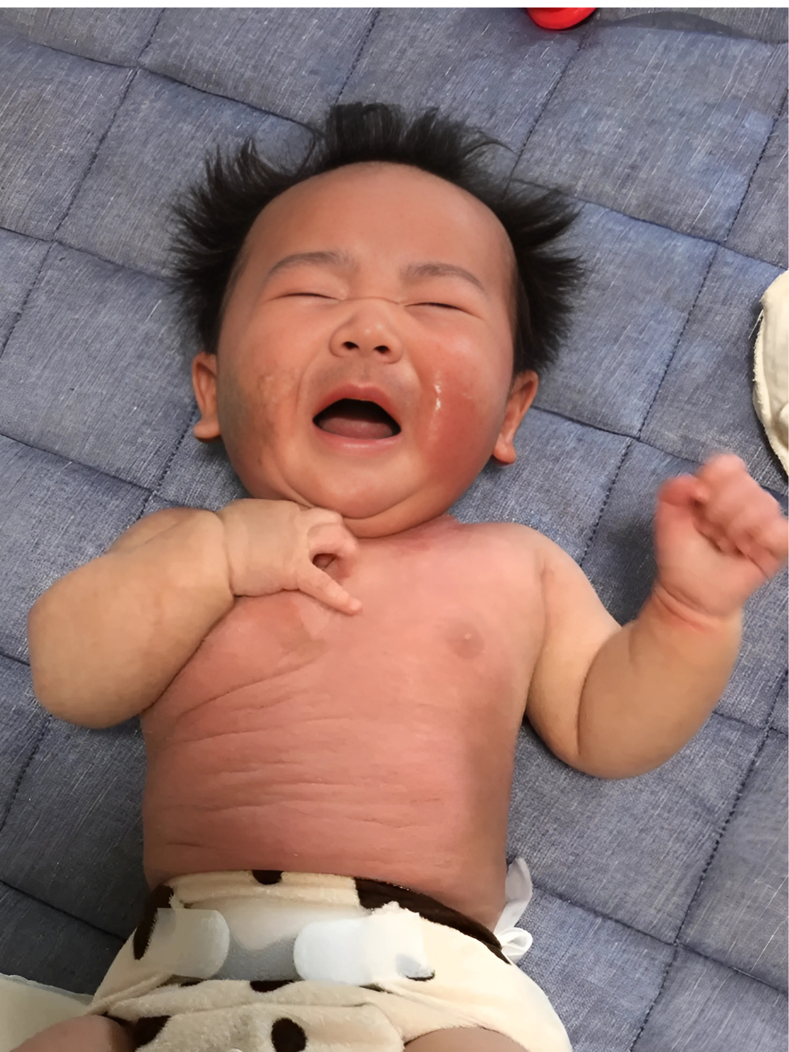 アトピーの子供